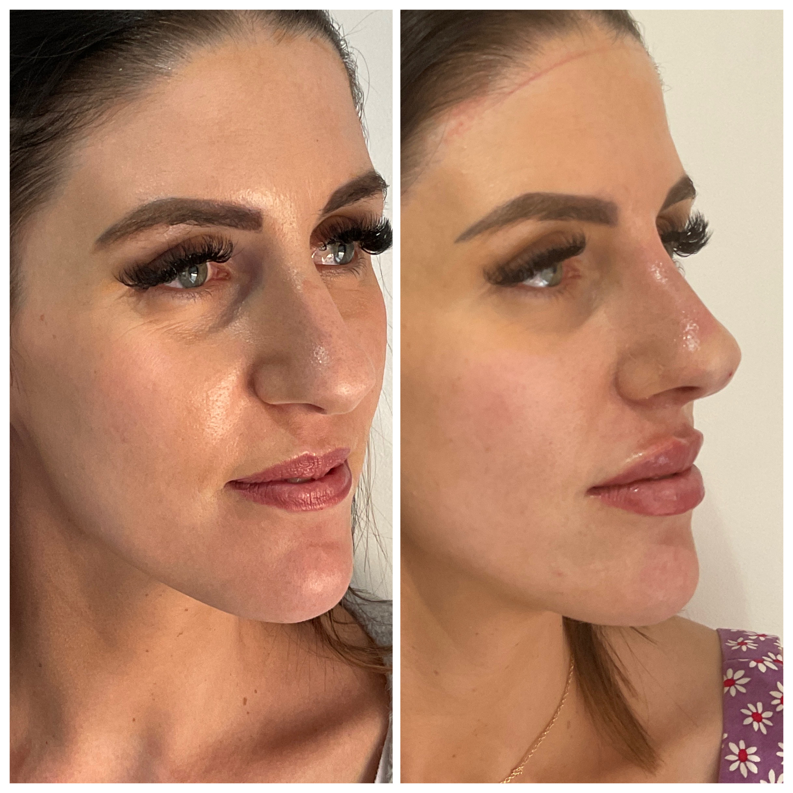 Lip Enhancement & Facial Contouring