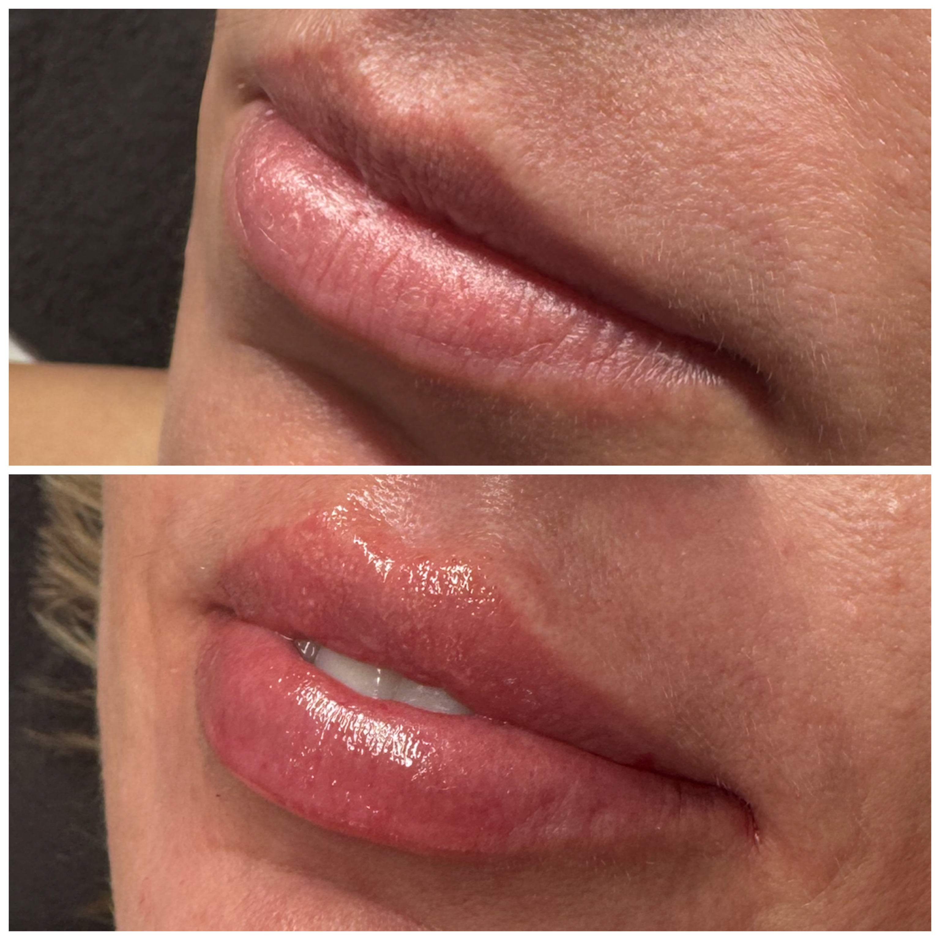 Lip Enhancement