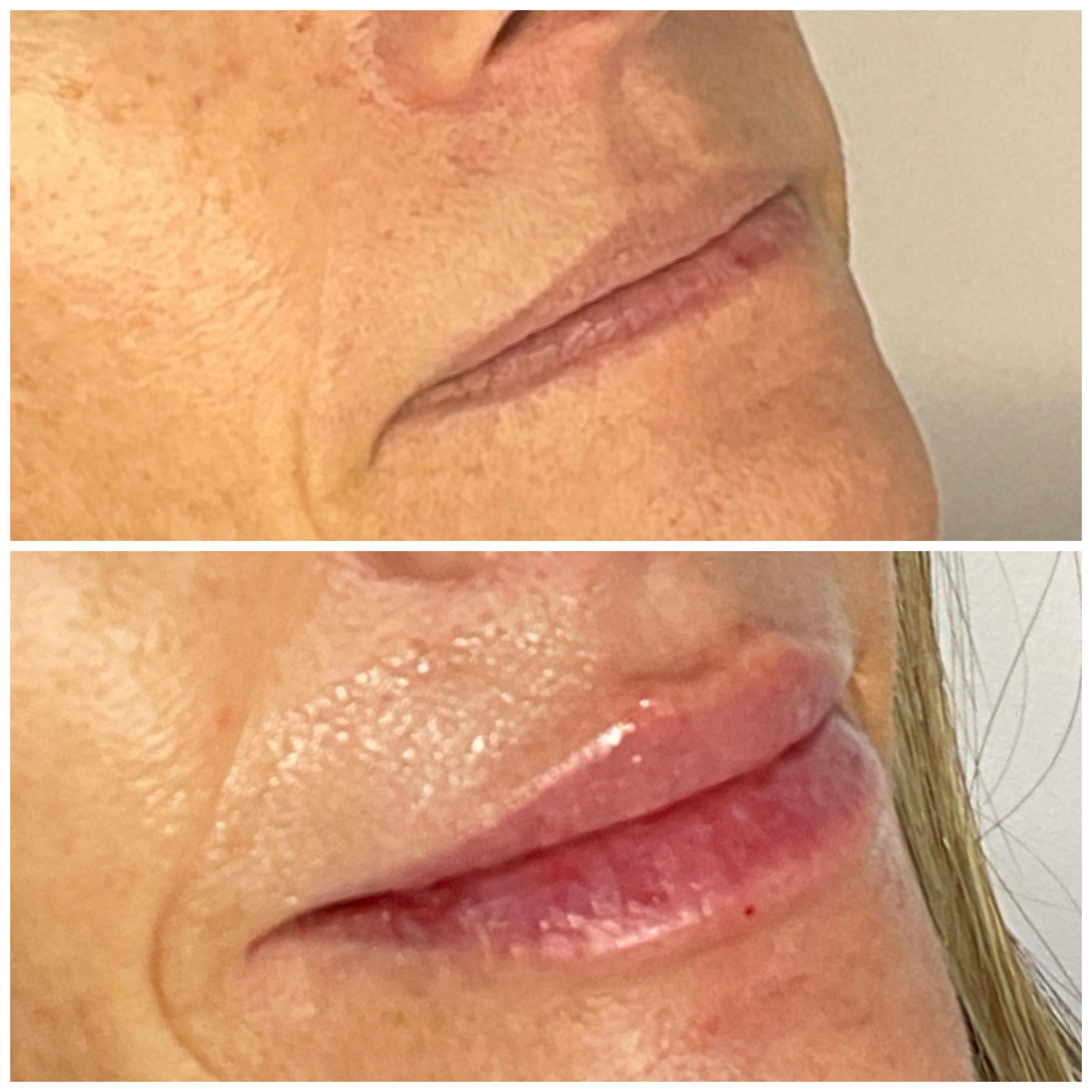 Lip Enhancement