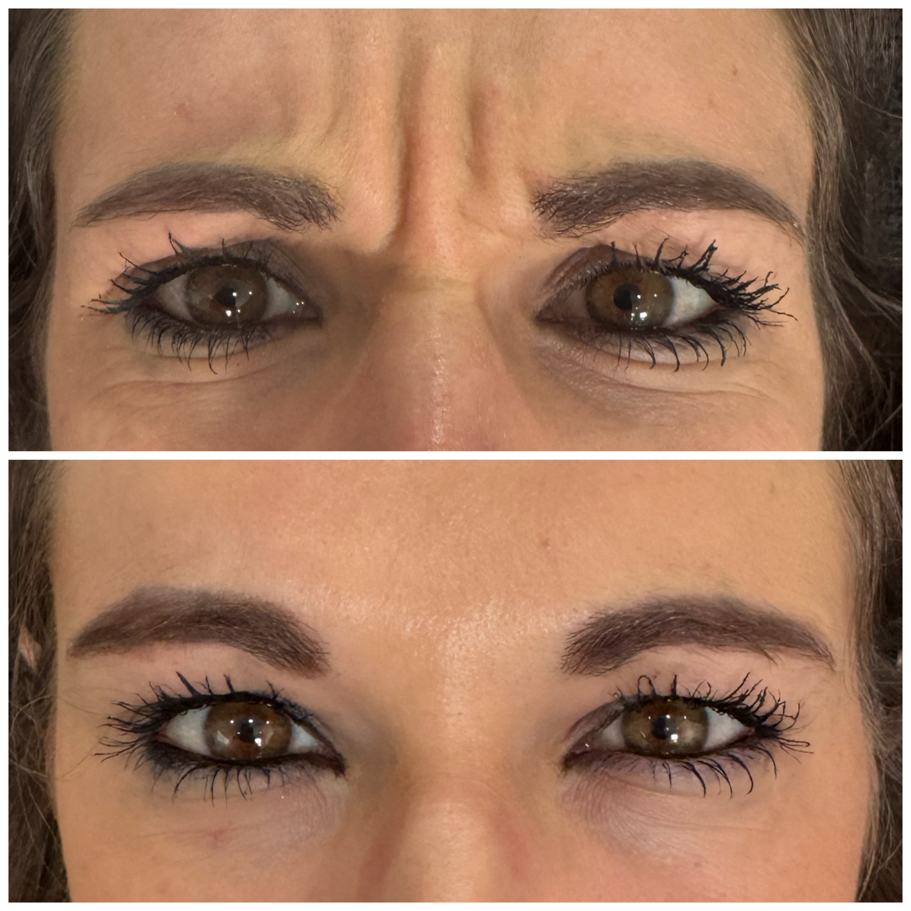 Botox — Forehead & Frown Lines