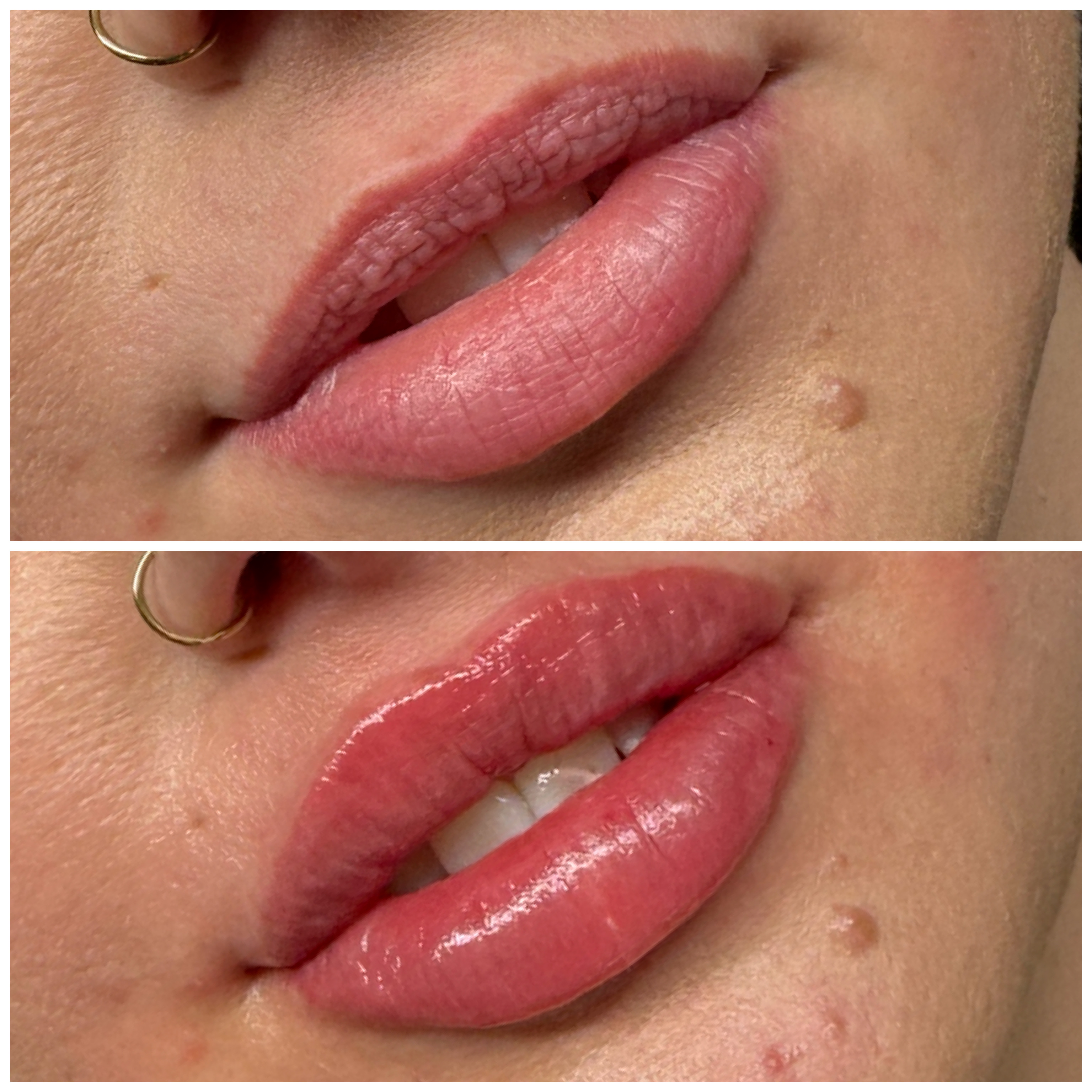 Lip Enhancement