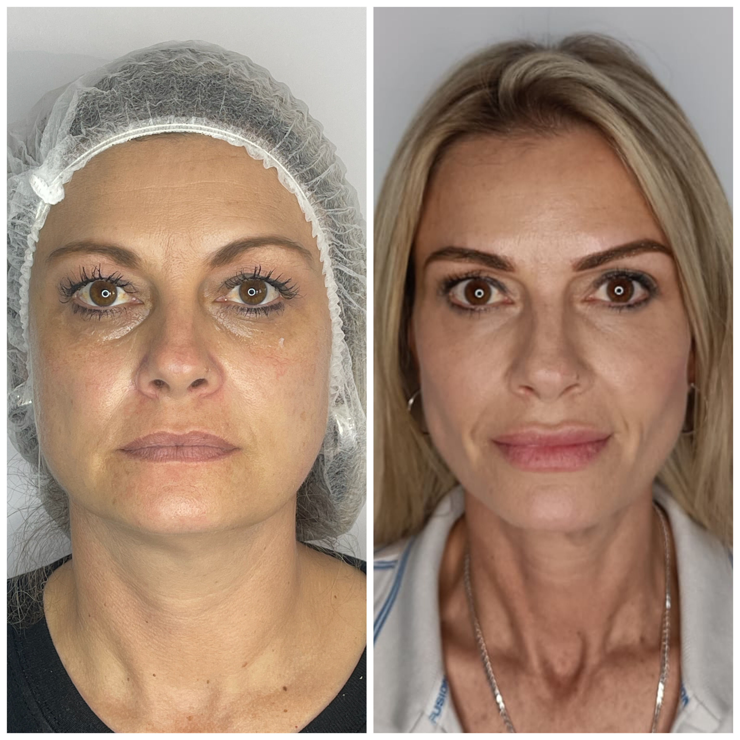 Wrinkle Reduction & Rejuvenation