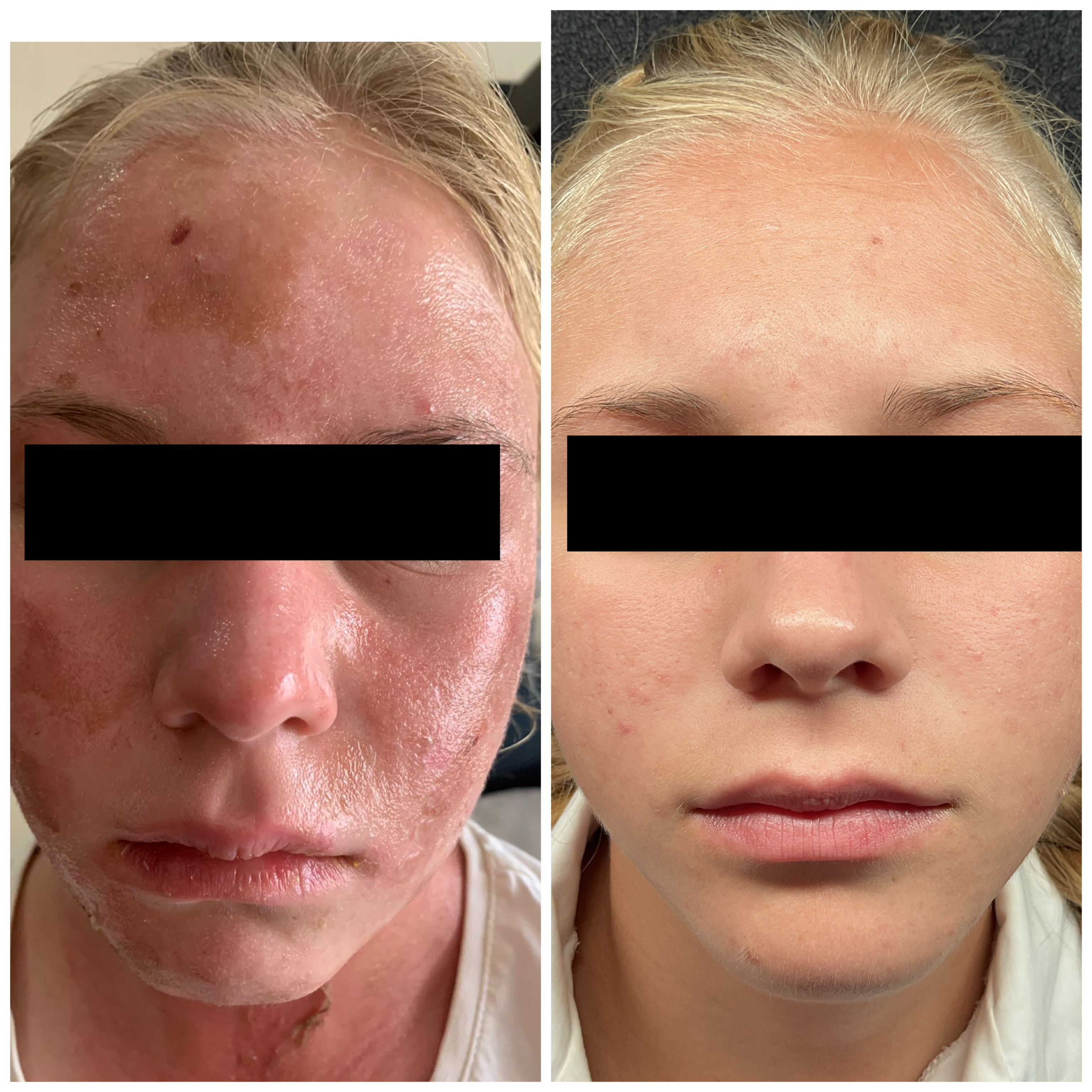 Skin Resurfacing