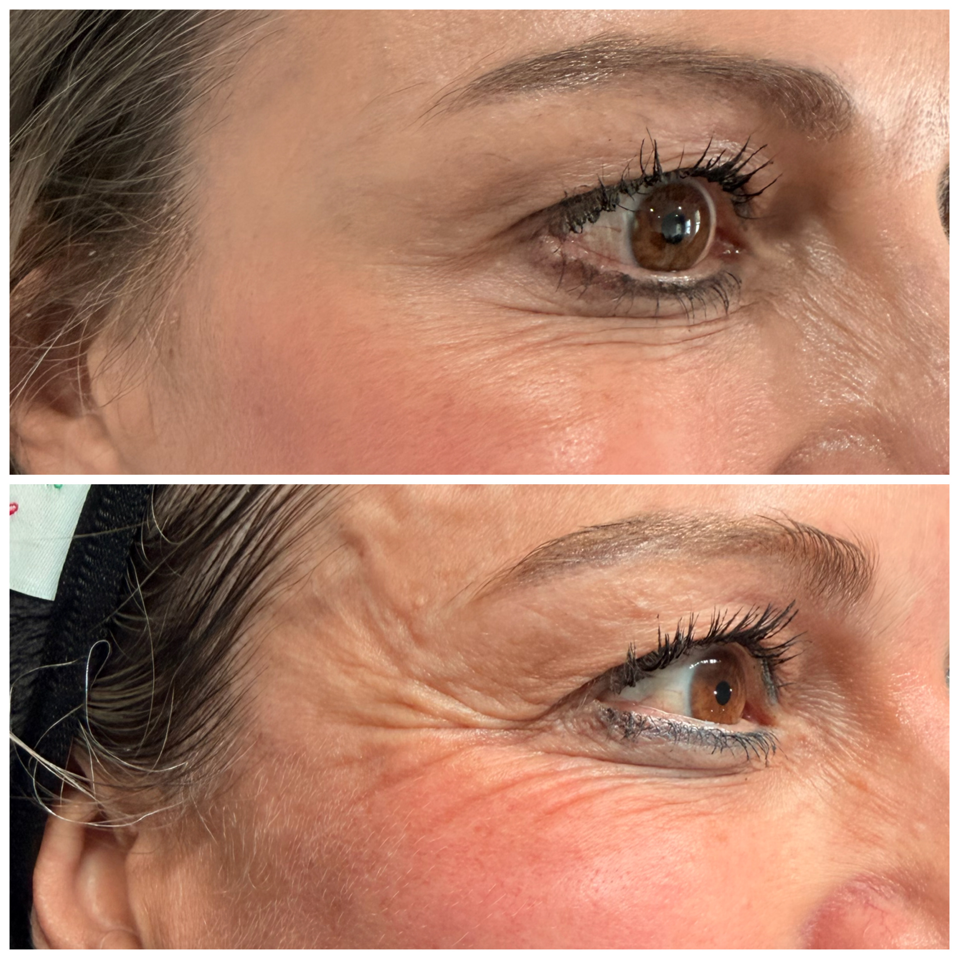 Botox — Crow's Feet