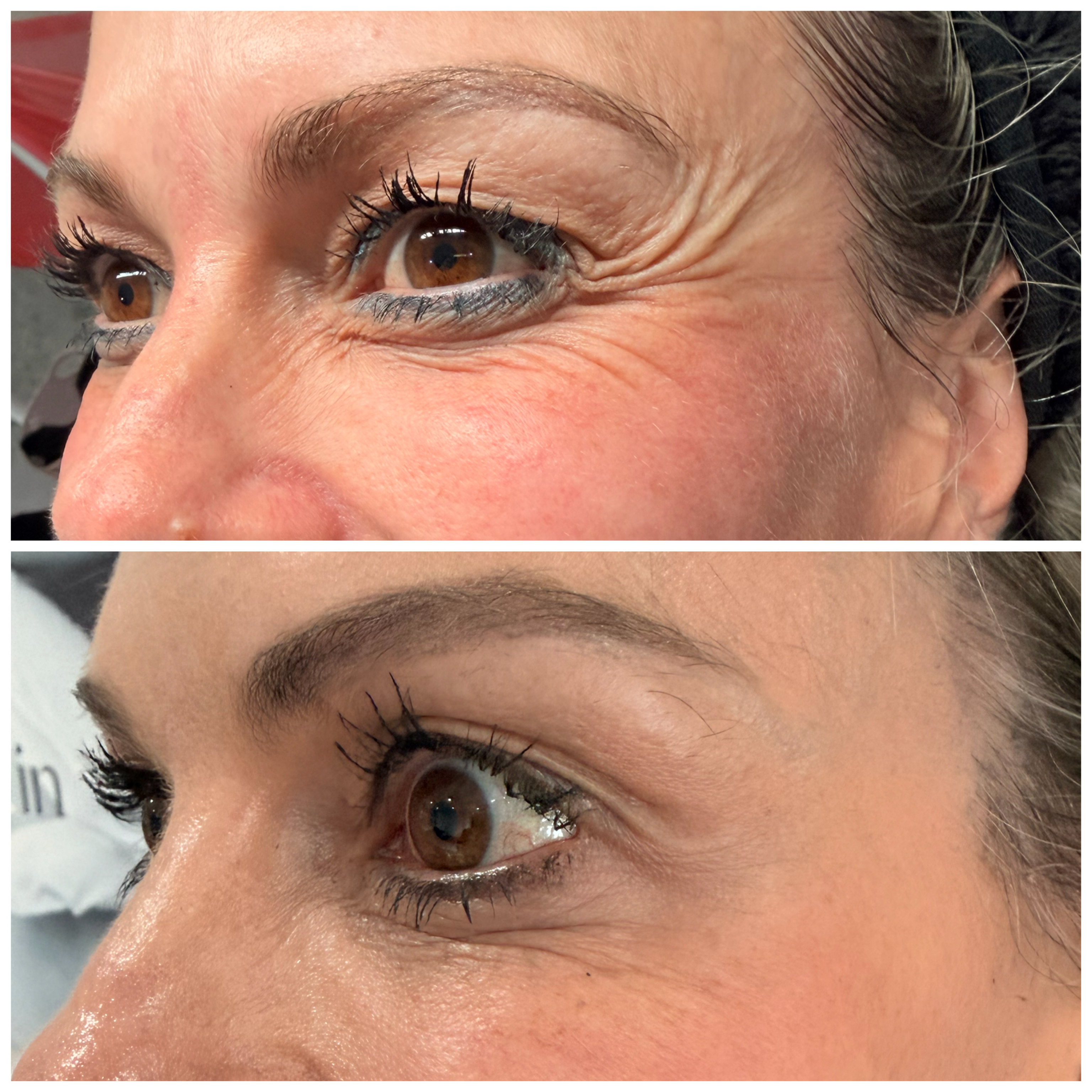 Botox — Crow's Feet