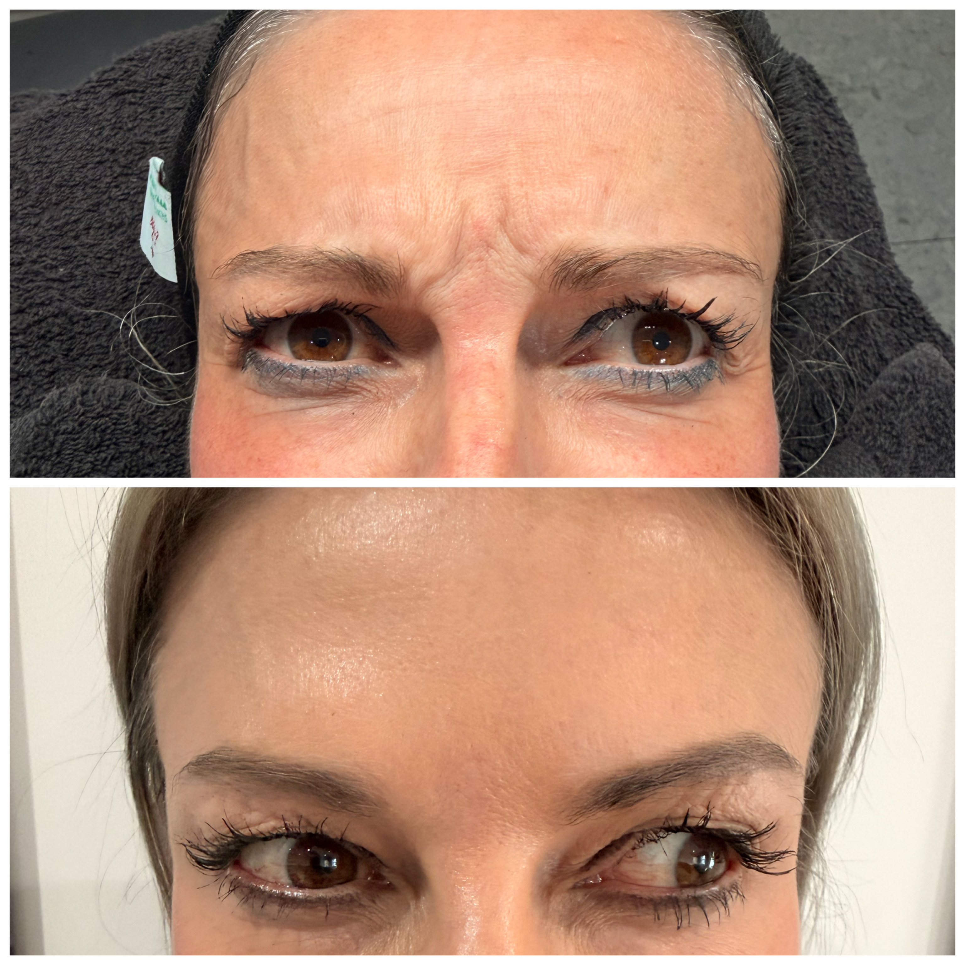 Botox — Forehead & Glabellar