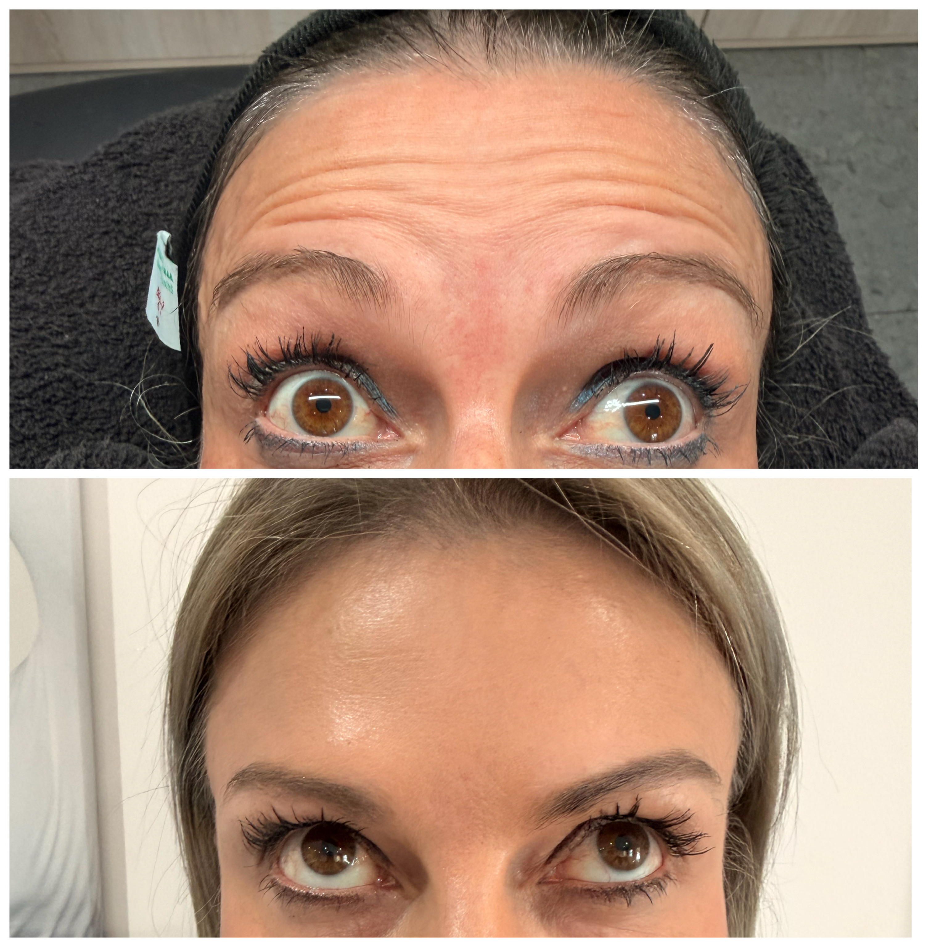 Botox — Forehead Lines