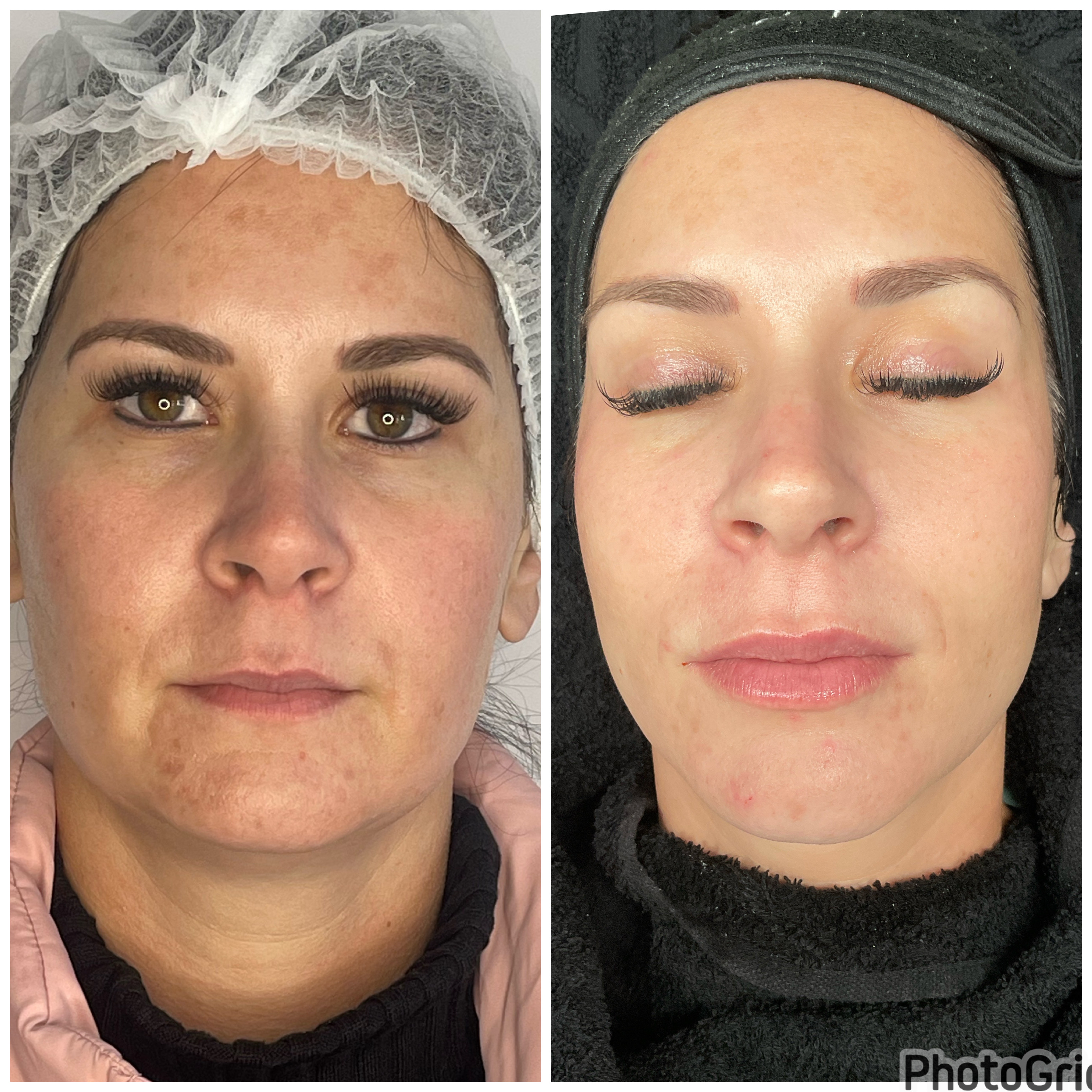 Skin Rejuvenation